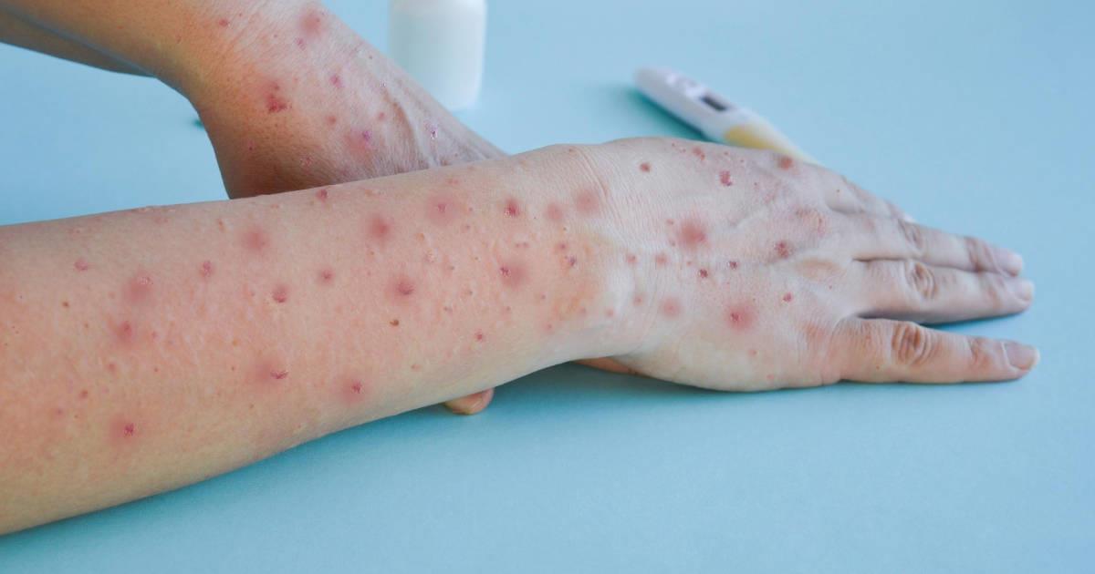 Pacientes con contagio de Mpox en Sonora ya fueron dados de alta: SSA