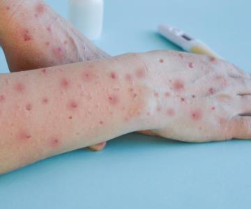 Pacientes con contagio de Mpox en Sonora ya fueron dados de alta: SSA