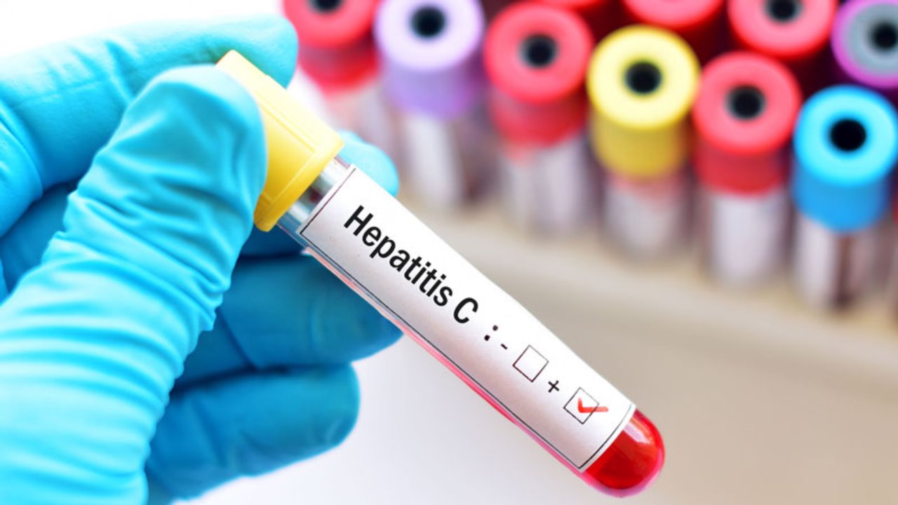 Repuntan casos de Hepatitis C a nivel nacional y estatal