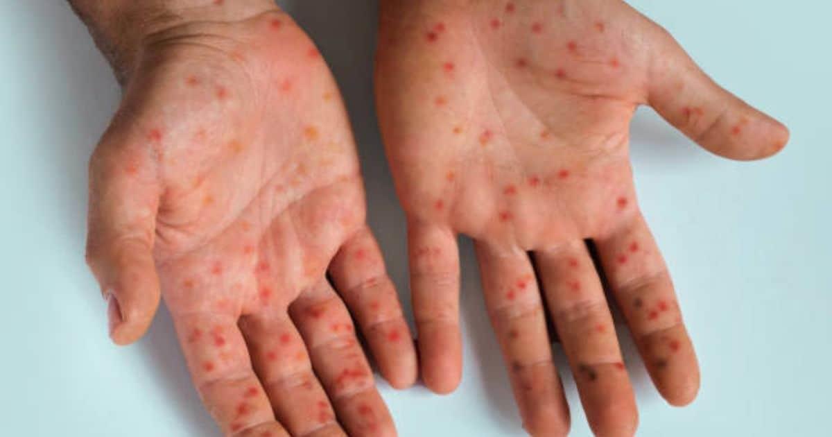 México aprueba vacuna ‘Jynneos’ contra la mpox para personas de alto riesgo