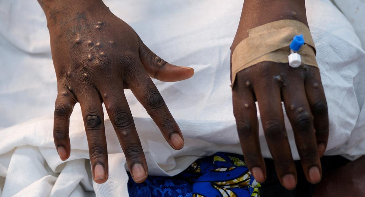 Reino Unido confirma primer caso de nueva variante de mpox en Londres