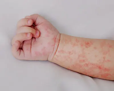 Muere bebé de un año por complicaciones de sarampión en Tlaxcala